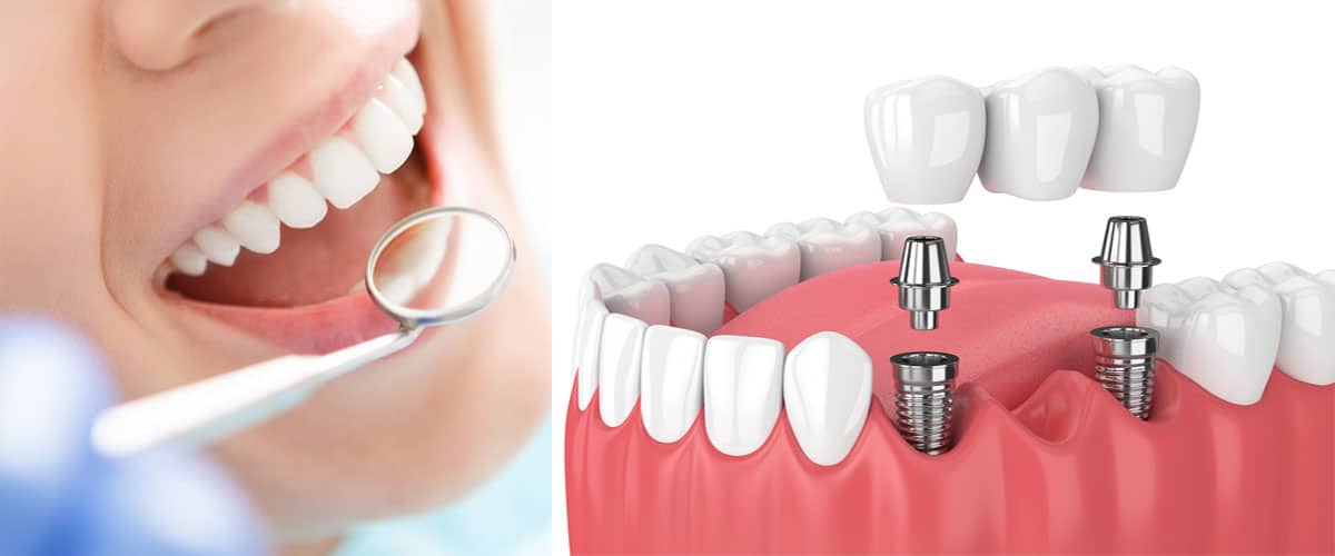 خدمات روکش دندان